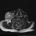 頸部轉移癌 MRI