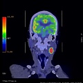 頸部轉移癌 neck metastatic cancer PET CT CORONAL 2