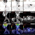 頸部多處轉移癌 neck metastatic cancer PET CT NECK