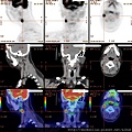 頸部轉移癌 neck metastatic cancer RIGHT NECK MASS PET CT BREAST CA