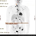 罕見全身轉移的甲狀腺腺癌 thyroid mucinous adenocarcinoma