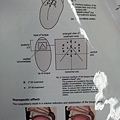 無線電波打鼾手術 Radiofrequency for Snoring & Sleep Apnea Syndrome