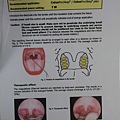 無線電波打鼾手術 Radiofrequency for Snoring & Sleep Apnea Syndrome