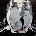 超過十公分的甲狀腺腫瘤 thyroid tumor bigger than 10 cm