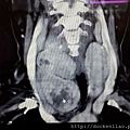 超過十公分的甲狀腺腫瘤 thyroid tumor bigger than 10 cm