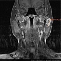 lt parotid tumor MRI cor.jpg