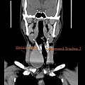 CT thyroid tumor compress trachea.jpg