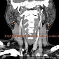 罕見的雙側腮腺結石 bilateral parotid sialolith CT