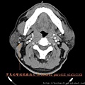 罕見的雙側腮腺結石 bilateral parotid sialolith CT axi