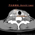 thyroid tumor CT size axi.jpg