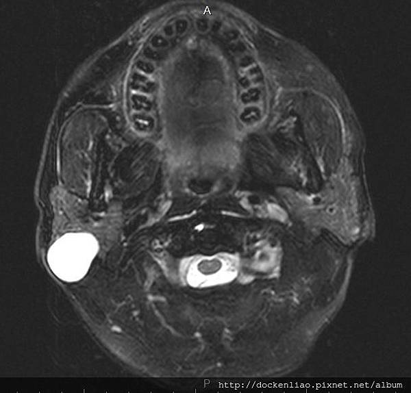 rt parotid tumor MRI T2.jpg