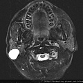 rt parotid tumor MRI T2.jpg