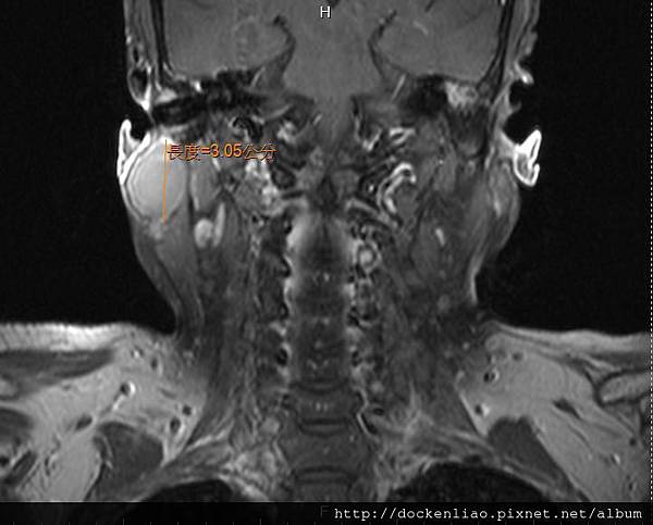 rt parotid tumor MRI T1 cor.jpg