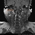 rt parotid tumor MRI T1 cor.jpg