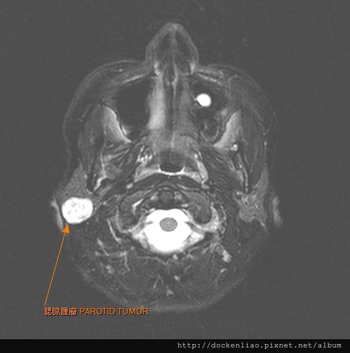 PAROTID TUMOR MRI AXI1.jpg