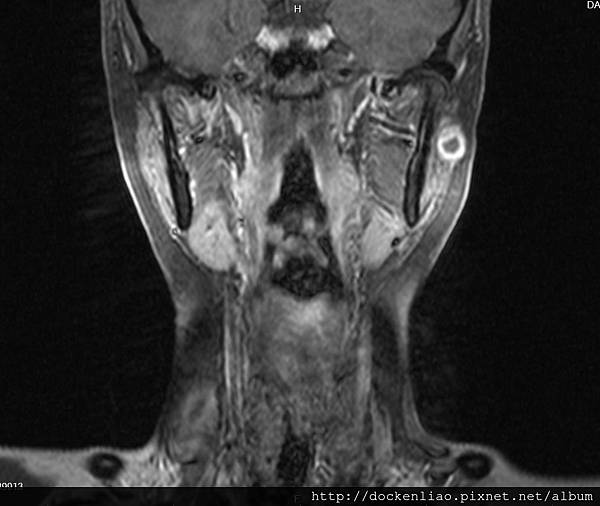 parotid tumor  MRI cor.jpg