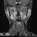 parotid tumor  MRI cor.jpg