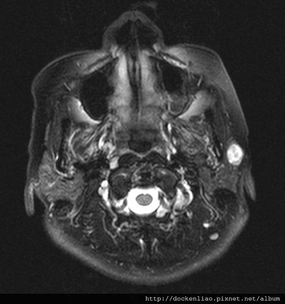 parotid tumor  MRI axi.jpg