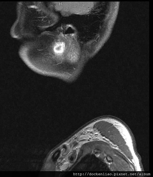 parotid tumor  MRI sag.jpg