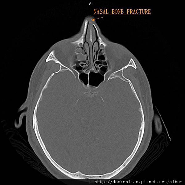 鼻骨骨折彎曲 DNS CHR NASAL BONE FRACTURE CT AXI 3