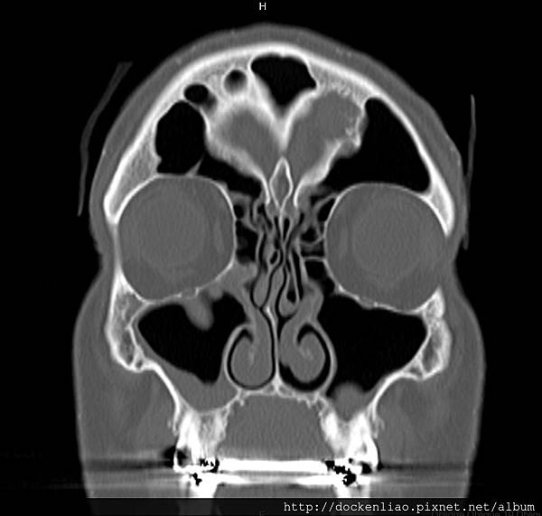 鼻中膈彎曲 鼻甲肥大DNS CHR NASAL BONE FRACTURE CT COR 1