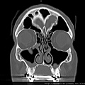 鼻中膈彎曲 鼻甲肥大DNS CHR NASAL BONE FRACTURE CT COR 1