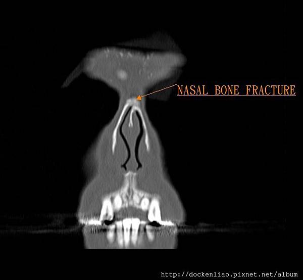 鼻骨骨折彎曲 DNS CHR NASAL BONE FRACTURE CT COR 3