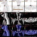 舌癌併發甲狀腺亢進 right tongue ca PET CT shows Thyroid hyperactivity