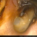 慢性外耳炎 chronic otitis externa