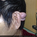 耳廓腫瘤 auricle tumor