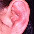 外耳帶狀泡疹 herpes zoster oticus