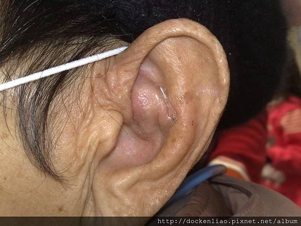 耳廓假性囊腫 auricle pseudocyst