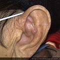 耳廓假性囊腫 auricle pseudocyst