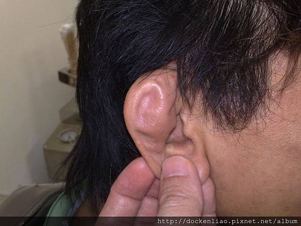 耳廓假性囊腫 auricle pseudocyst