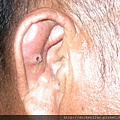 auricle tumor