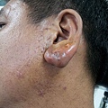 耳垂皮脂腺囊腫 sebaceous cyst , earlobe