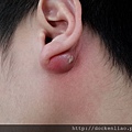 耳垂皮脂腺囊腫 sebaceous cyst , earlobe