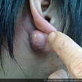 耳垂皮脂腺囊腫 sebaceous cyst , earlobe