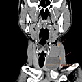 huge thyroid tumor CT cor 1.jpg