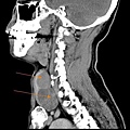 huge thyroid tumor CT sag 1.jpg