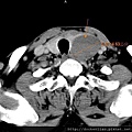 huge thyroid tumor CT axi 1.jpg