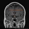 腦下垂體瘤 手術 MRI T1 cystic pituitary gland tumor