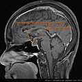 pituitary macroadenoma MRI T1 sag3.jpg