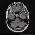 MRI T2 pituitary cystic tumor axi.jpg