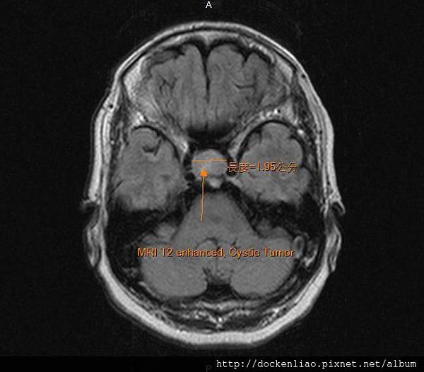 MRI T2 pituitary cystic tumor axi2.jpg