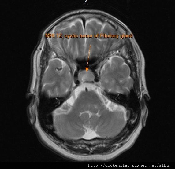 MRI T2 pituitary cystic tumor axi3.jpg