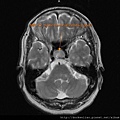 MRI T2 pituitary cystic tumor axi3.jpg