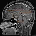pituitary macroadenoma MRI sag2.jpg