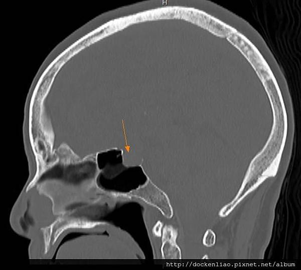 pituitary macroadenoma CT sag1.jpg