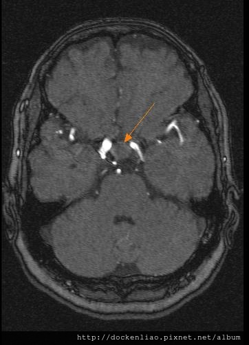 pituitary macroadenoma MRI axi3.jpg